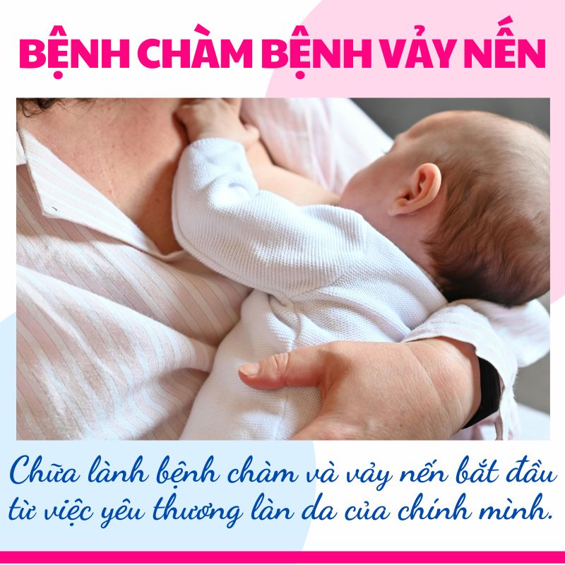 Bệnh chàm vẩy nên khi cho bé ti