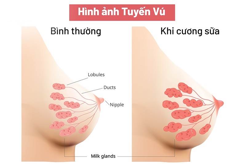 Mẹ bị căng sữa, không tiết ra sữa phải làm sao?