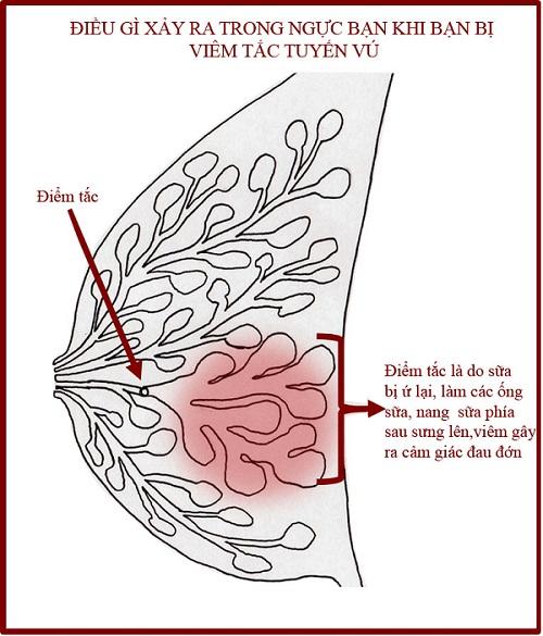 Mẹ bị căng sữa sau sinh có nguy hiểm không?