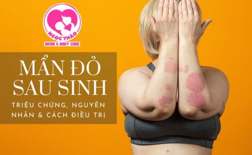 Mẩn đỏ sau khi sinh