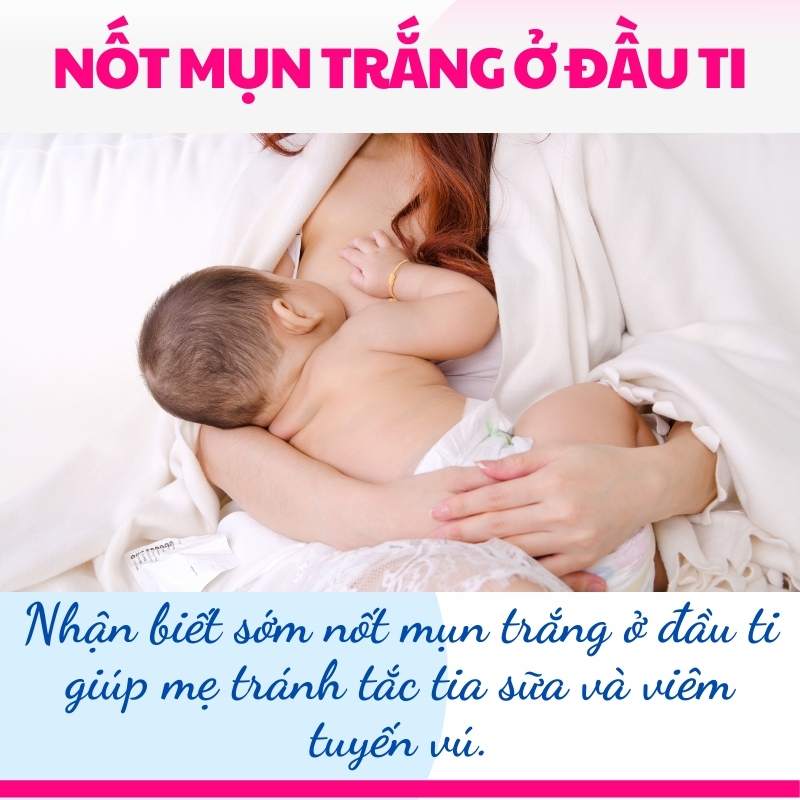 Dấu hiệu nhận biết nốt mụn trắng ở đầu ti