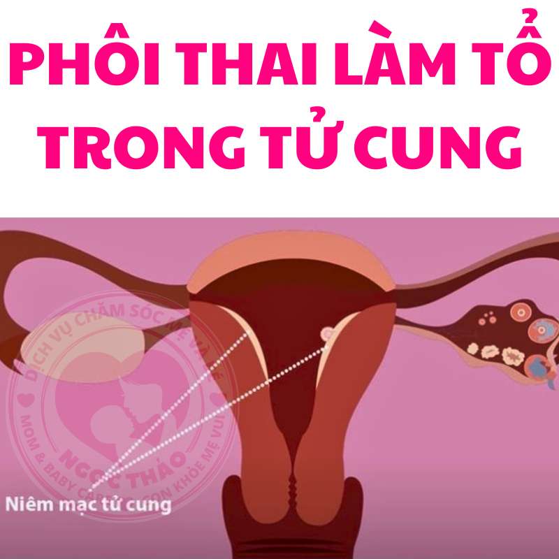 Phôi thai làm tổ trong niêm mạc tử cung