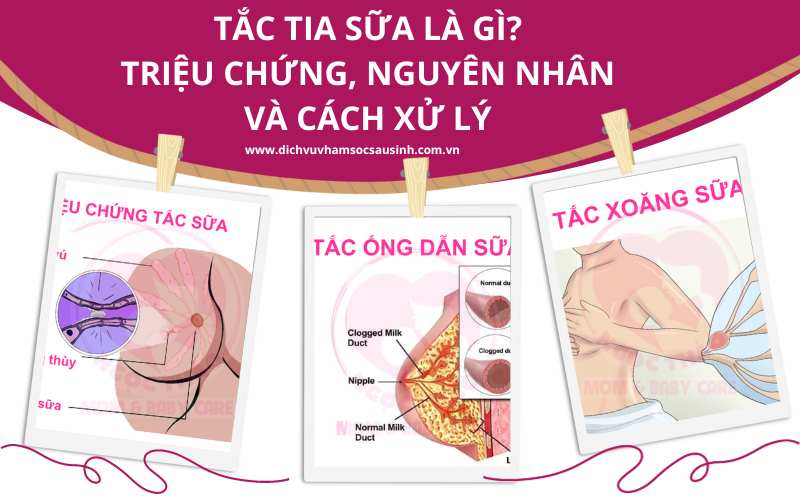 Tắc tia sữa là gì? Nguyên nhân và cách xử lý tình trạng tắc tia sữa sau sinh