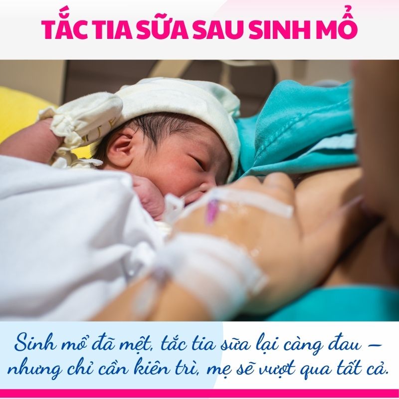 Giải pháp xử lý tắc tia sữa sau sinh mổ hiệu quả, không gây đau nhức
